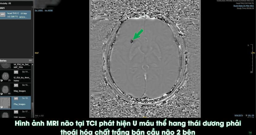 U máu thể hang có hình gì?