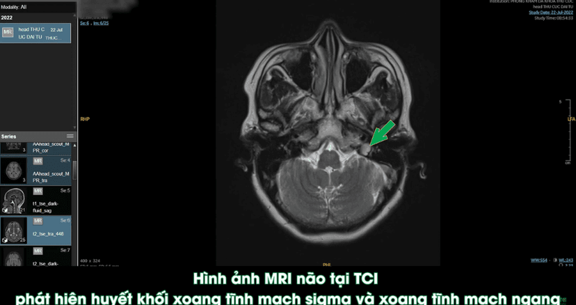 Huyết khối tĩnh mạch – Cục máu đông tĩnh mạch não nguy hiểm