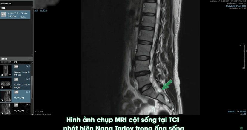 Bệnh Nang rễ thần kinh trông như thế nào?