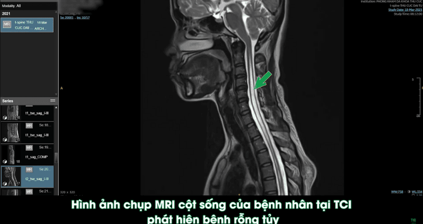 Bệnh rỗng tủy – căn bệnh rất hiếm gặp