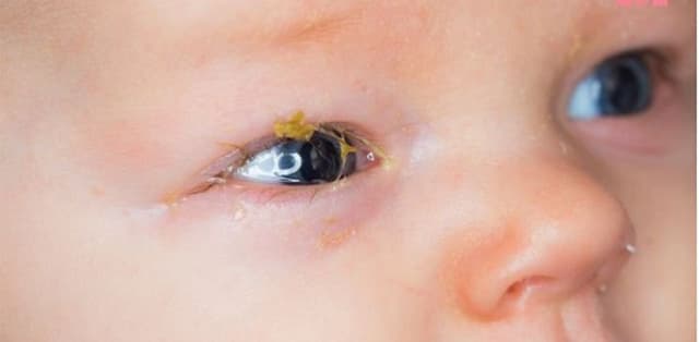 Điều trị cho bé bị viêm bờ mi mắt