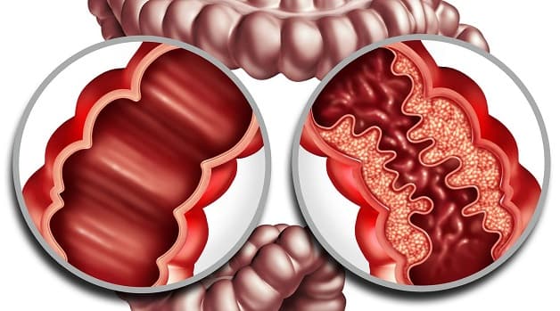 Biến chứng bệnh Crohn có nguy hiểm không