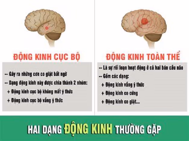 động kinh cục bộ