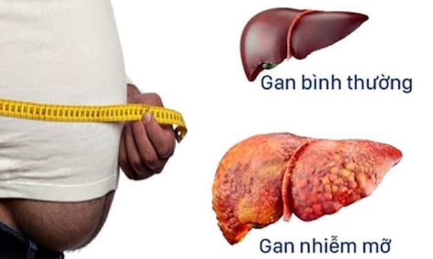 Gan nhiễm mỡ là bệnh gì?