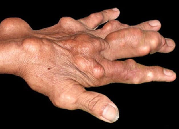 Gout cũng là một trong những nguyên nhân dẫn đến viêm dây thần kinh cổ tay