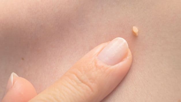 Bệnh sùi mào gà xuất hiện với các nốt sần nhỏ màu hồng hoặc trắng hống, kích thước từ 1 - 2mm sau đó có thể lớn dần và gom thành các khối sùi lớn