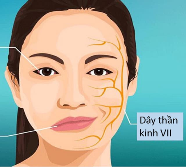 Hiểu về liệt dây thần kinh số 7 ngoại biên (liệt mặt)