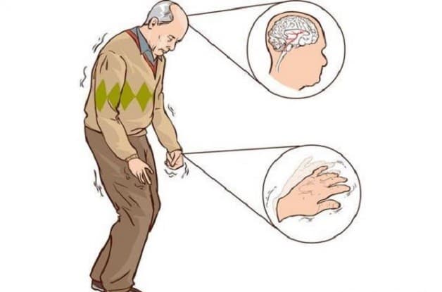 bệnh rối loạn vận động trường hợp parkinson