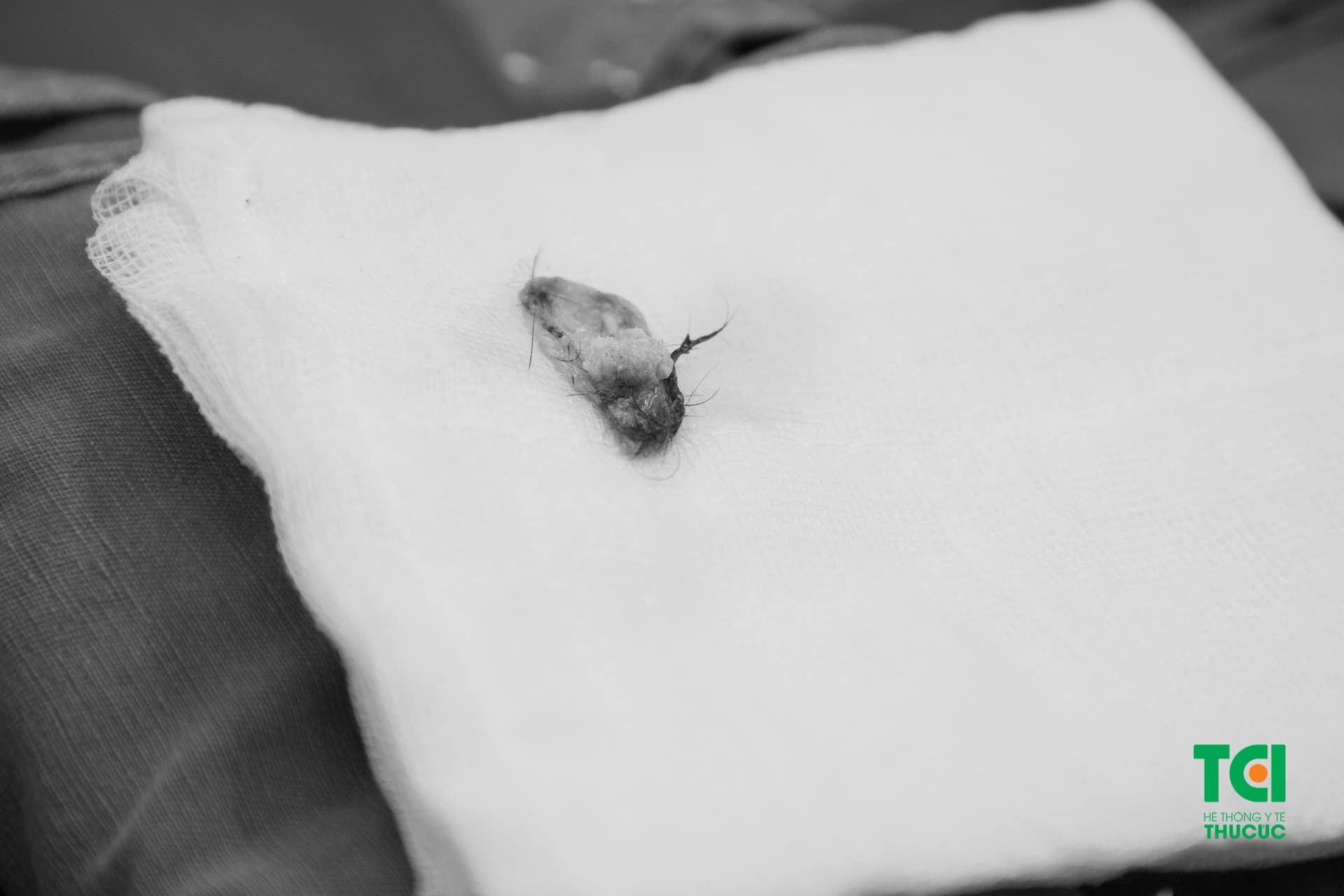 Hình ảnh khối nang nang bì buồng trứng chứa đầy tóc bên trong