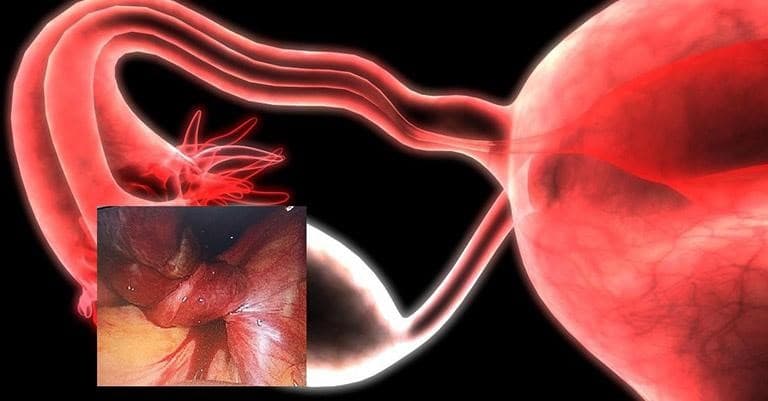 Bệnh u buồng trứng đa phần lành tính nhưng vẫn có thể tiến triển và dẫn đến biến chứng nguy hiểm như xoắn nang