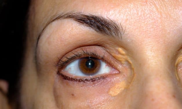 Nguyên nhân mắc bệnh u vàng mí mắt.