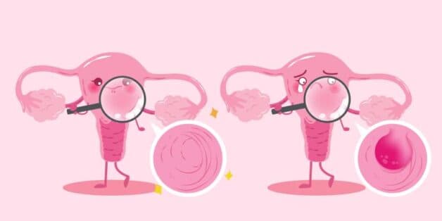 Diễn biến ung thư cổ tử cung giai đoạn 3 và điều trị