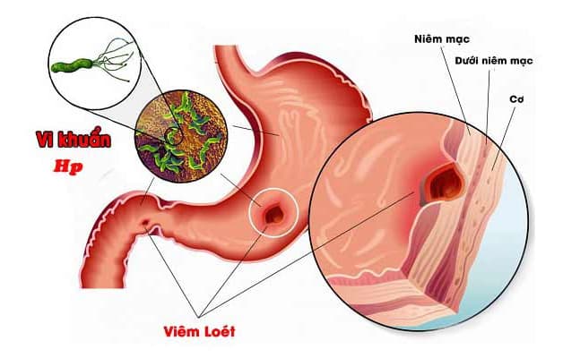Người bệnh bị HP dạ dày có tổn thương thực thể được chỉ định điều trị tiêu diệt