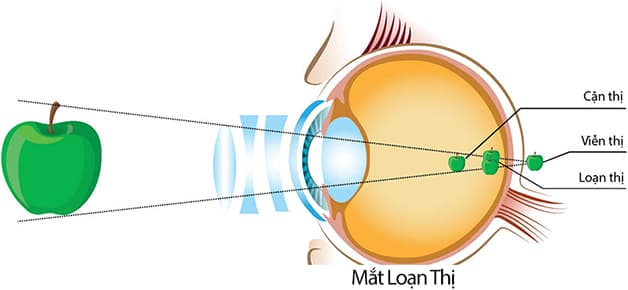 bị loạn thị có đeo lens được không