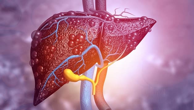 biến chứng của bệnh gan nhiễm mỡ 