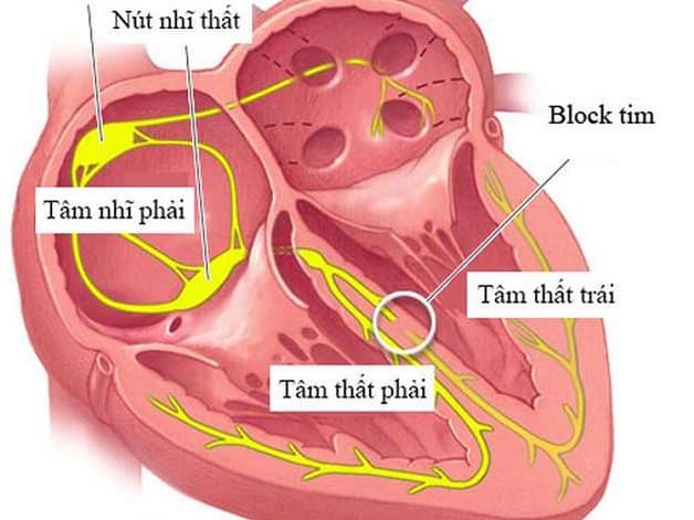 Rối loạn nhịp tim dạng block nhánh phải
