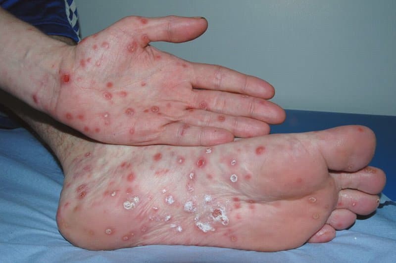 Bệnh tình dục (STDs) là từ để định nghĩa những bệnh nhiễm trùng lây truyền qua đường tình dục