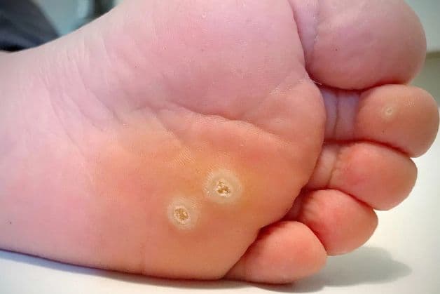 Các đường lây bệnh sùi mào gà và cách phòng tránh