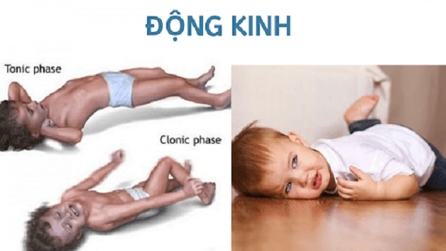 động kinh cục bộ
