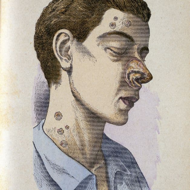 Các triệu chứng của bệnh giang mai thường thấy