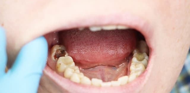 Cách chữa răng sâu an toàn và hiệu quả