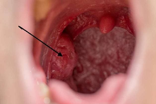 Sàng lọc ung thư họng là gì