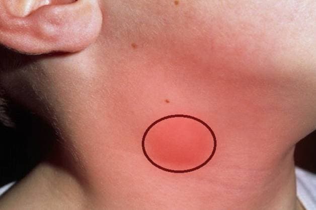 khi nào nên sàng lọc ung thư họng