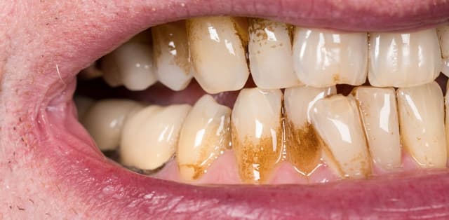 Cao răng huyết thanh có nguy hiểm không?