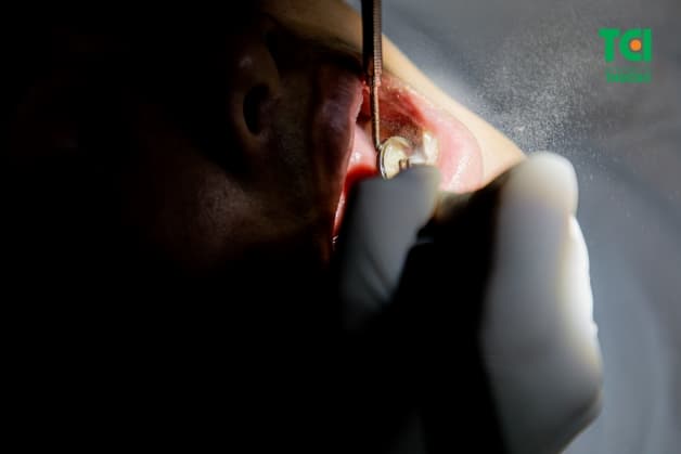 chăm sóc răng sâu tại nhà