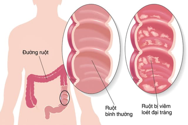 Chữa viêm đại tràng tại nhà như thế nào?