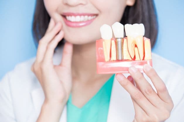 Công nghệ trồng răng Implant là gì?