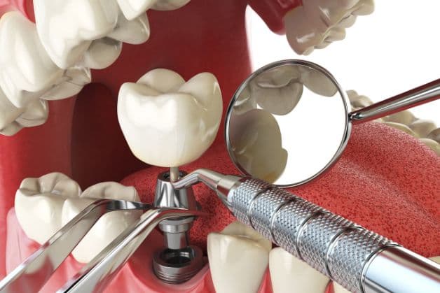 Quy trình công nghệ trồng răng Implant.