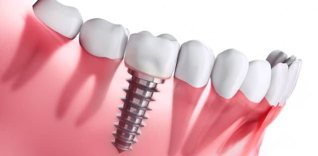 Tìm hiểu về công nghệ trồng răng Implant