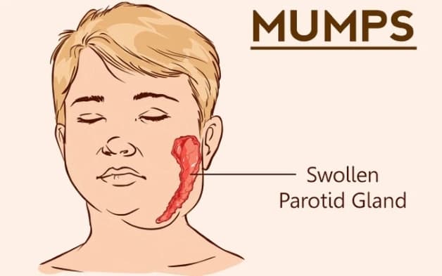 dấu hiệu nhận biết bệnh quai bị