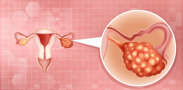 Các dấu hiệu u xơ tử cung ác tính không thể bỏ qua