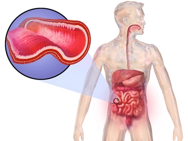 Điều trị bệnh Crohn