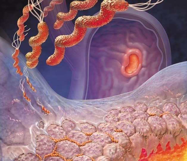 Điều trị HP dạ dày