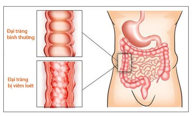 điều trị viêm loét đại tràng theo hướng dẫn của bác sĩ
