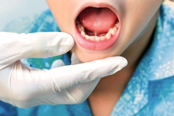 Dính thắng lưỡi là dị tật bẩm sinh ở lưỡi khiến trẻ gặp khó khăn khi ăn uống