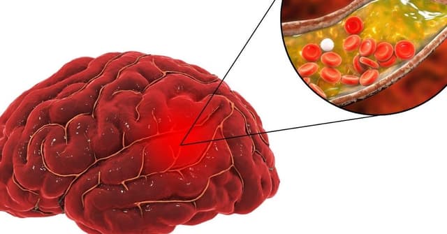 Những điều cần biết về chứng đột quỵ não cấp tính