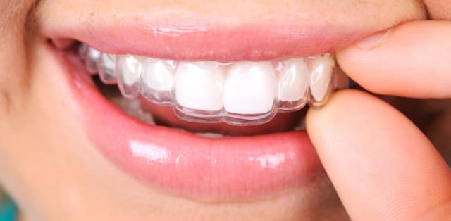 Vì sao lại bị ê răng khi đeo hàm duy trì?