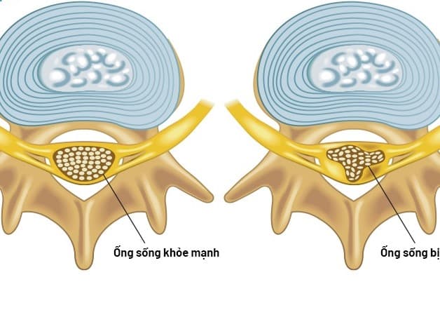 Hình ảnh hẹp đốt sống cổ