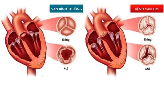 Hình ảnh so sánh giữa tim khỏe mạnh và hở van tim