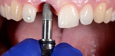 Các kỹ thuật phục hình răng phổ biến và an toàn