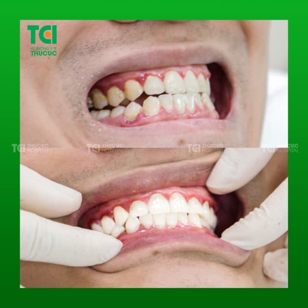 lấy cao răng tại nhà đơn giản