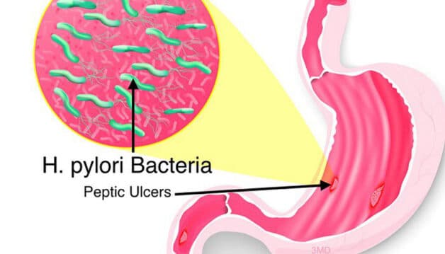 Vi khuẩn HP là tác nhân chủ yếu gây lở loét bao tử 