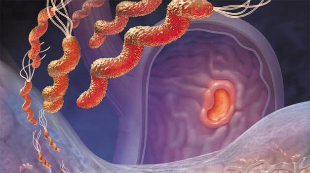 Vi khuẩn HP (tên đầy đủ là Helicobacter Pylori), có hình dạng chữ S, dài khoảng 1,5 - 5 µm, là một loại vi khuẩn tồn tại trong môi trường axit dạ dày.