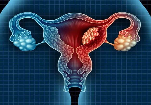 Nang đơn thùy buồng trứng có thể phát triển kích thước lên đến 30mm