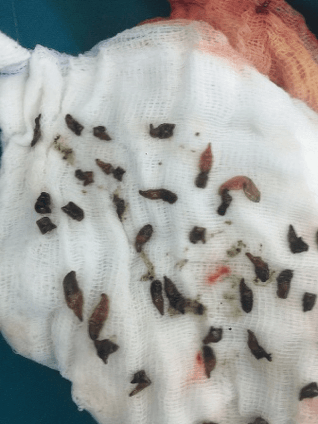 Nguyên nhân bị sán lá gan thường gặp là gì? 