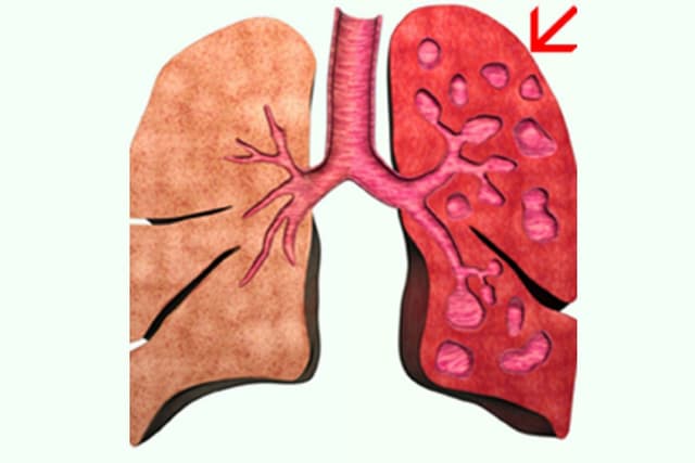 Nguyên nhân dẫn đến giãn phế quản do đâu?